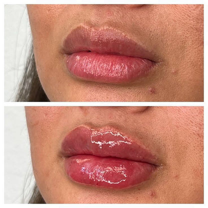 Microneedle Lip Filler Training