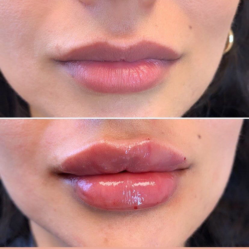 Microneedle Lip Filler Training